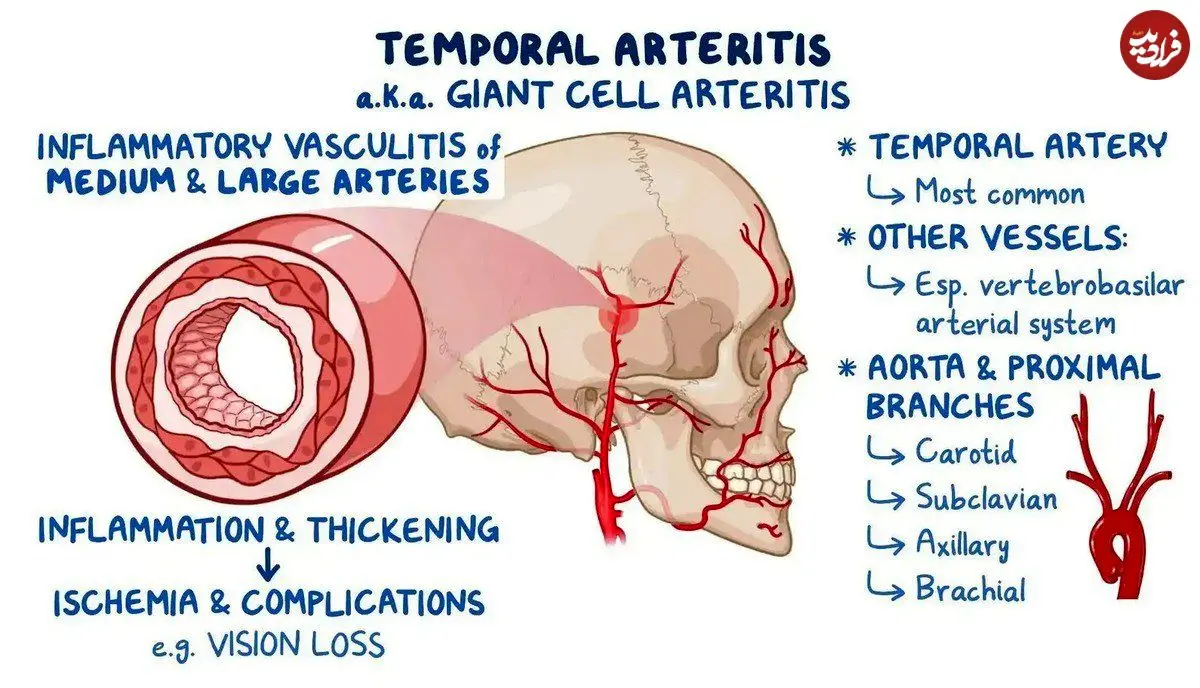 چرا سردرد شقیقه پس از ۵۰ سالگی همیشه باید جدی گرفته شود؟