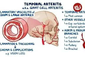 چرا سردرد شقیقه پس از ۵۰ سالگی همیشه باید جدی گرفته شود؟