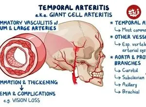 چرا سردرد شقیقه پس از ۵۰ سالگی همیشه باید جدی گرفته شود؟