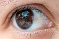 همه چیز درباره ناخنک چشم
