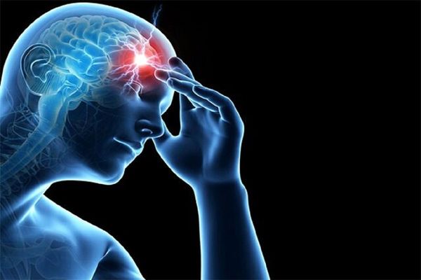سکته‌های مغزی مکرر می‌توانند به زوال عقل عروقی منجر شوند