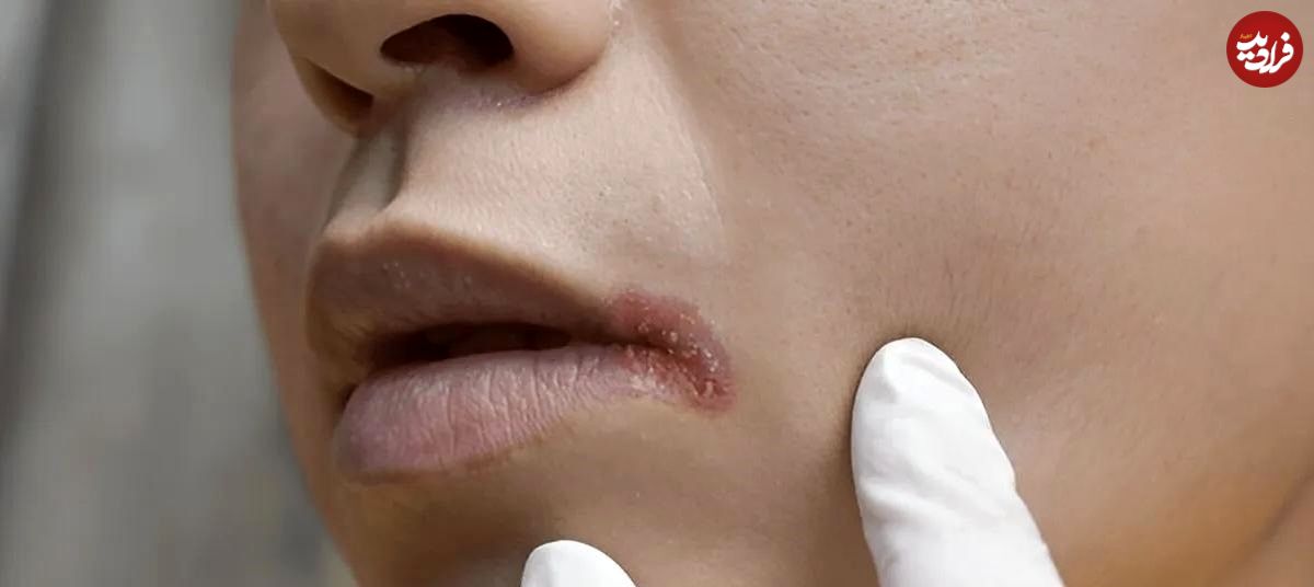 چرا گوشه‌های دهان ترک می‌خورند؟ ردپای کمبود ویتامین‌ها