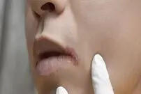 چرا گوشه‌های دهان ترک می‌خورند؟ ردپای کمبود ویتامین‌ها