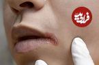 چرا گوشه‌های دهان ترک می‌خورند؟ ردپای کمبود ویتامین‌ها
