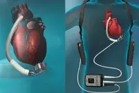 (عکس) زن آمریکایی، نبض ندارد و با باتری زندگی می‌کند