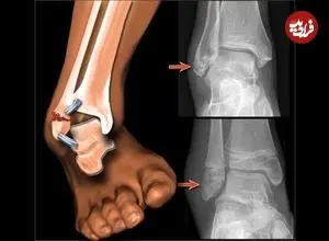 راهنمای نجات جان مصدوم؛ کمک‌های اولیه «شکستگی» در شرایط جنگی و بحران/ آتل‌بندی به روش صحیح و ساده