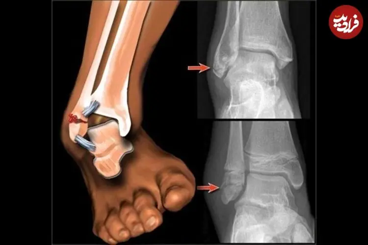 راهنمای نجات جان مصدوم؛ کمک‌های اولیه «شکستگی» در شرایط جنگی و بحران/ آتل‌بندی به روش صحیح و ساده
