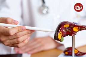 ۶ مکمل‌ و ویتامین برای کنترل بیماری کبد چرب