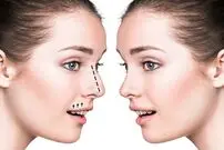 (ویدیو) چطوری میتوان اشتیاق به‌ عمل زیبایی بینی را کاهش داد؟