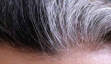 کدام ویتامین ها ریزش موی مرتبط با تیروئید را متوقف می‌کنند؟