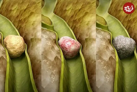 سنگ کیسه صفرا چطور ایجاد می‌شود؟