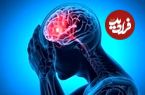 شایع‌ترین علت خونریزی مغزی را بشناسیم
