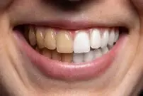 آیا «جرم‌گیری» به دندان‌ها آسیب می‌رساند؟