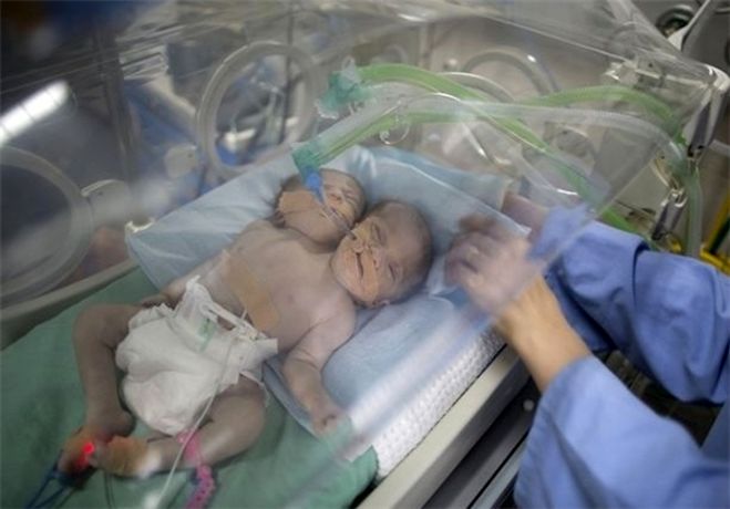 تصویری از یک نوزاد دو سر که پربازدید شد
