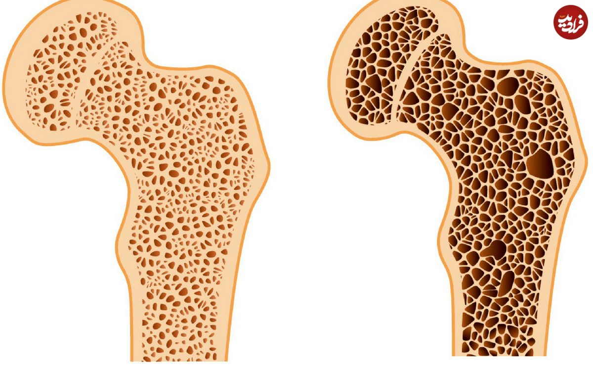 اگر پوکی استخوان دارید، بخوانید