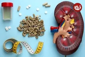 این مواد غذایی باعث تشکیل سنگ کلیه می‌شوند