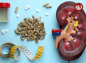 این مواد غذایی باعث تشکیل سنگ کلیه می‌شوند