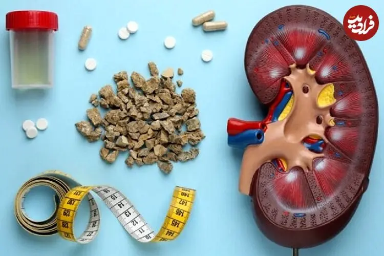 این مواد غذایی باعث تشکیل سنگ کلیه می‌شوند