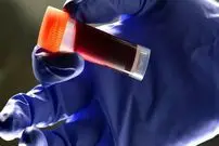 کدام گروه خونی بیشتر در معرض سکتۀ مغزی است؟