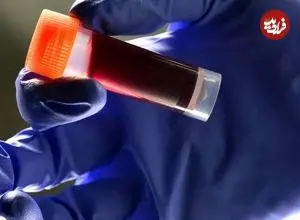 کدام گروه خونی بیشتر در معرض سکتۀ مغزی است؟