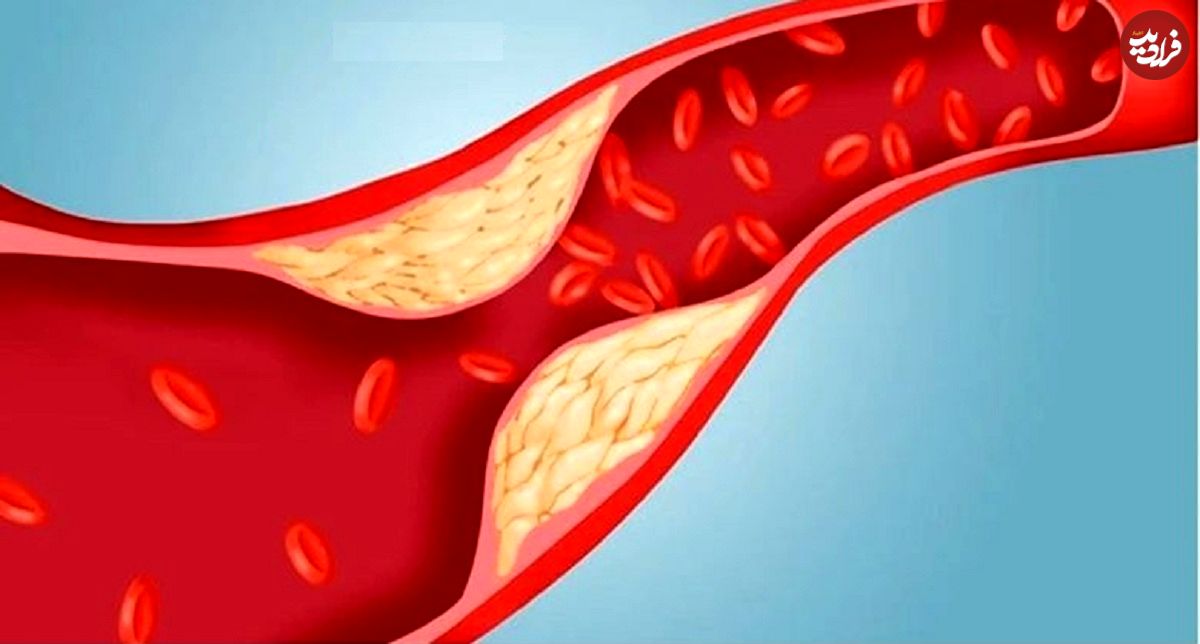 ۱۱ ماده غذایی مفید برای کاهش چربی خون