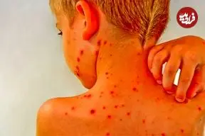 آنچه والدین باید درباره آبله‌مرغان و زونا بدانند