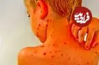 آنچه والدین باید درباره آبله‌مرغان و زونا بدانند