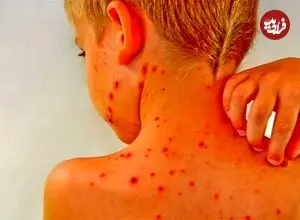 آنچه والدین باید درباره آبله‌مرغان و زونا بدانند