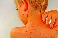 آنچه والدین باید درباره آبله‌مرغان و زونا بدانند