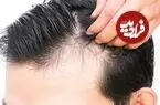 چرا موها ناگهان بیشتر از همیشه می ریزند؟ 6 علت مهم