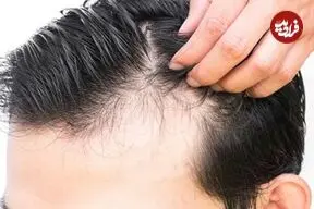چرا موها ناگهان بیشتر از همیشه می ریزند؟ 6 علت مهم