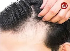 چرا موها ناگهان بیشتر از همیشه می ریزند؟ 6 علت مهم