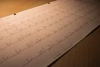 از سندرم مرگ ناگهانی بزرگسالان چه می‌دانید؟
