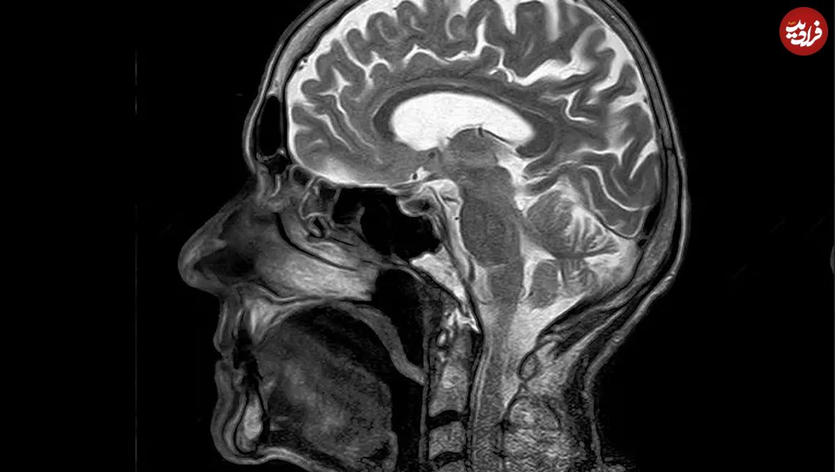  کشف جدید دانشمندان؛ چرا مغز انسان تا این حد بزرگ است؟