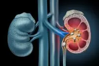 (عکس) بزرگترین سنگ کلیه جهان در بدن بیمار سریلانکایی