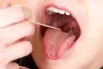 نقش لوزه‌ها در سیستم ایمنی بدن