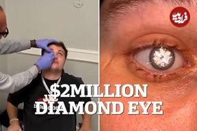 تصاویر| چشم مصنوعی با الماس ۲ قیراطی مردی که شبیه شرورهای جیمز باند است!