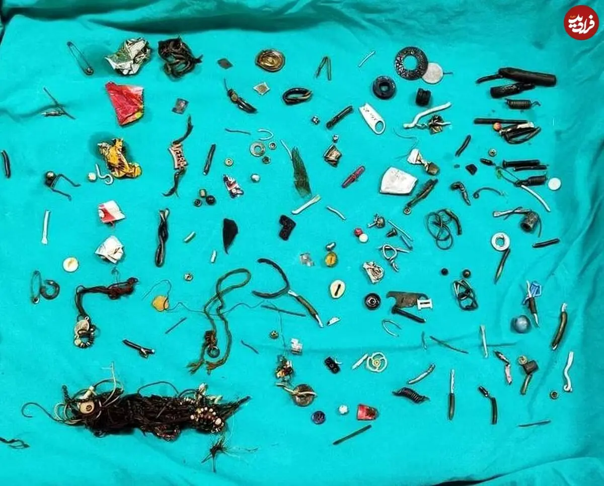 (تصاویر) محتویات شکم این مرد، همه را شگفت‌زده کرد