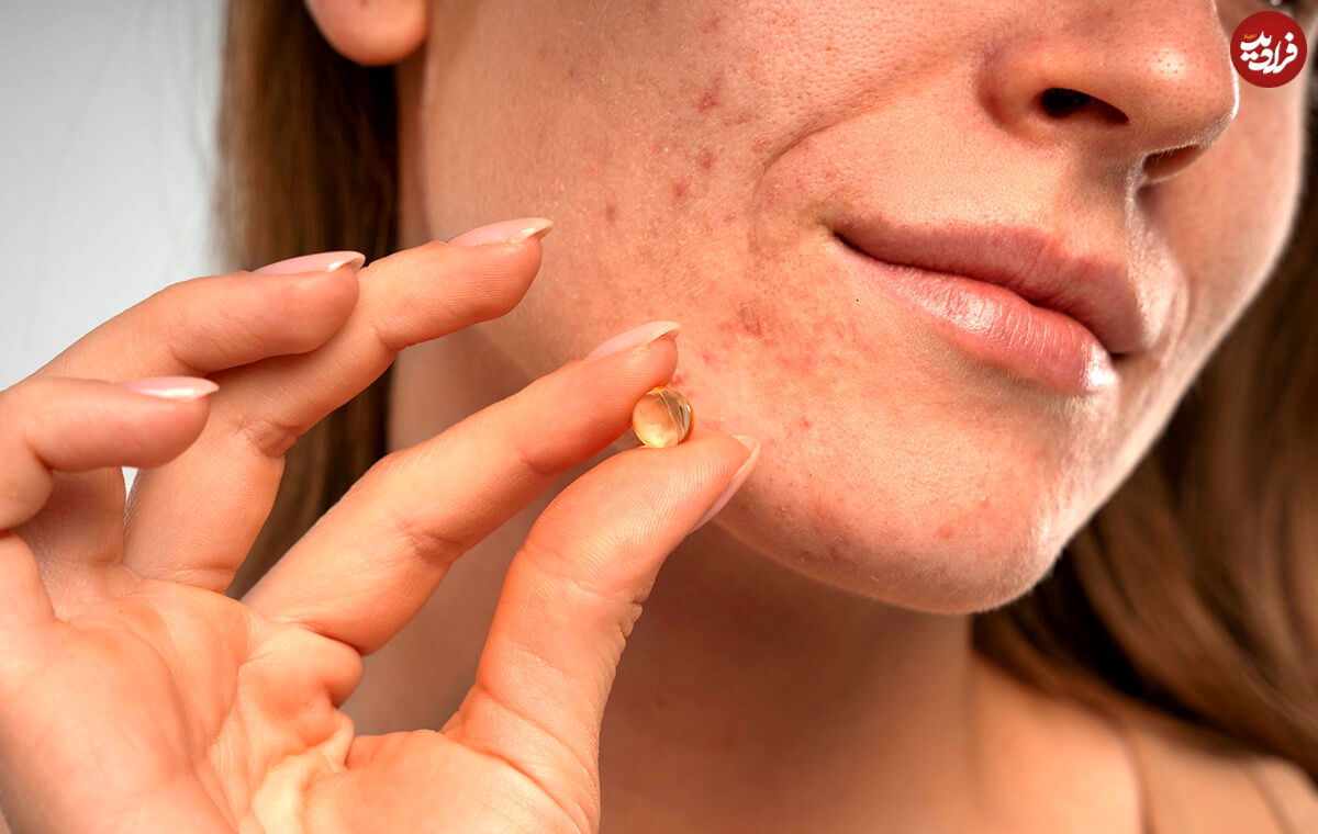 قرص استامینوفن برای جوش صورت؛ درمان موثر یا اشتباه رایج؟