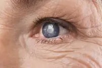 آیا لیزیک در دراز مدت سبب ایجاد آب مروارید می شود؟