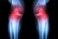 آزمایش موفقیت‌آمیز داروی جدیدی که می‌تواند «آرتروز» را درمان کند