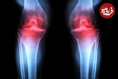 آزمایش موفقیت‌آمیز داروی جدیدی که می‌تواند «آرتروز» را درمان کند