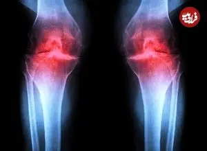 آزمایش موفقیت‌آمیز داروی جدیدی که می‌تواند «آرتروز» را درمان کند