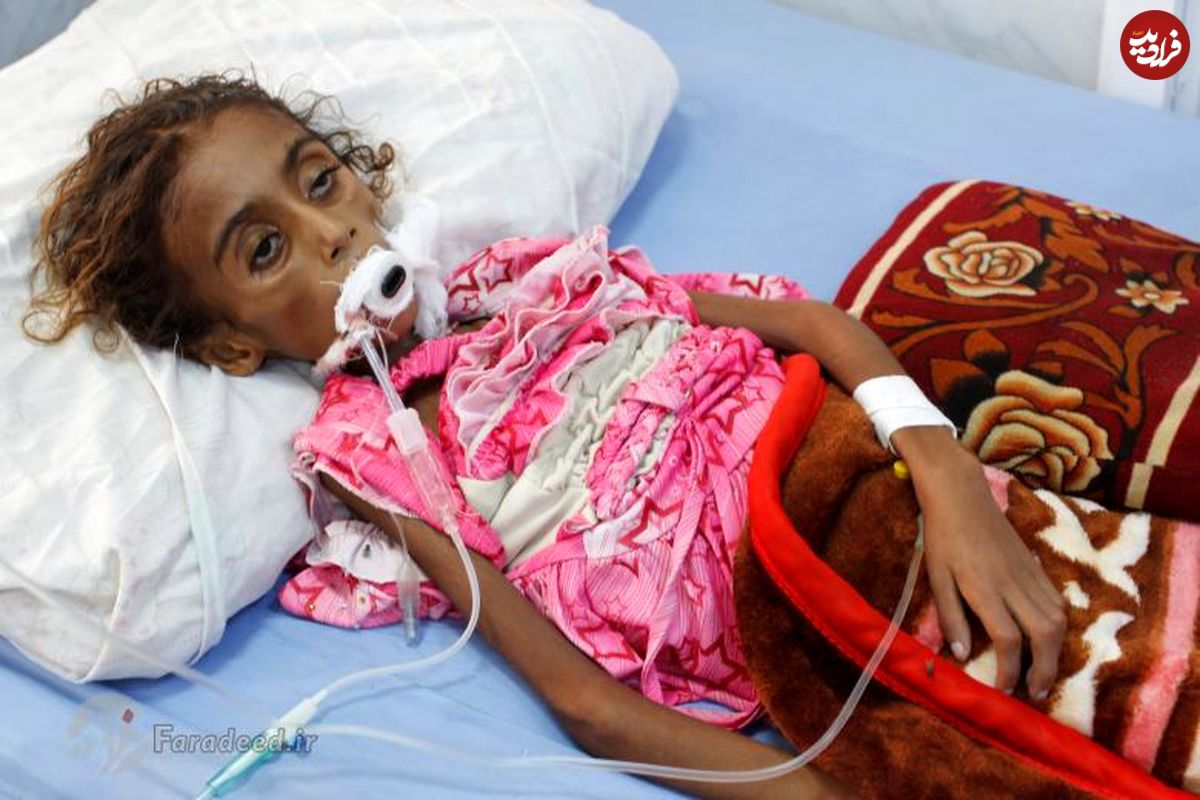 تصاویر/ مرگ دختر یمنی بر اثر سوءتغذیه