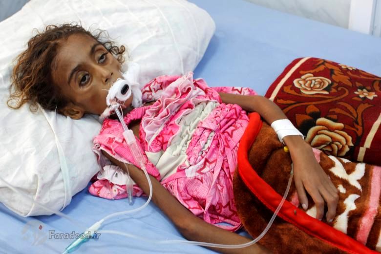 تصاویر/ مرگ دختر یمنی بر اثر سوءتغذیه
