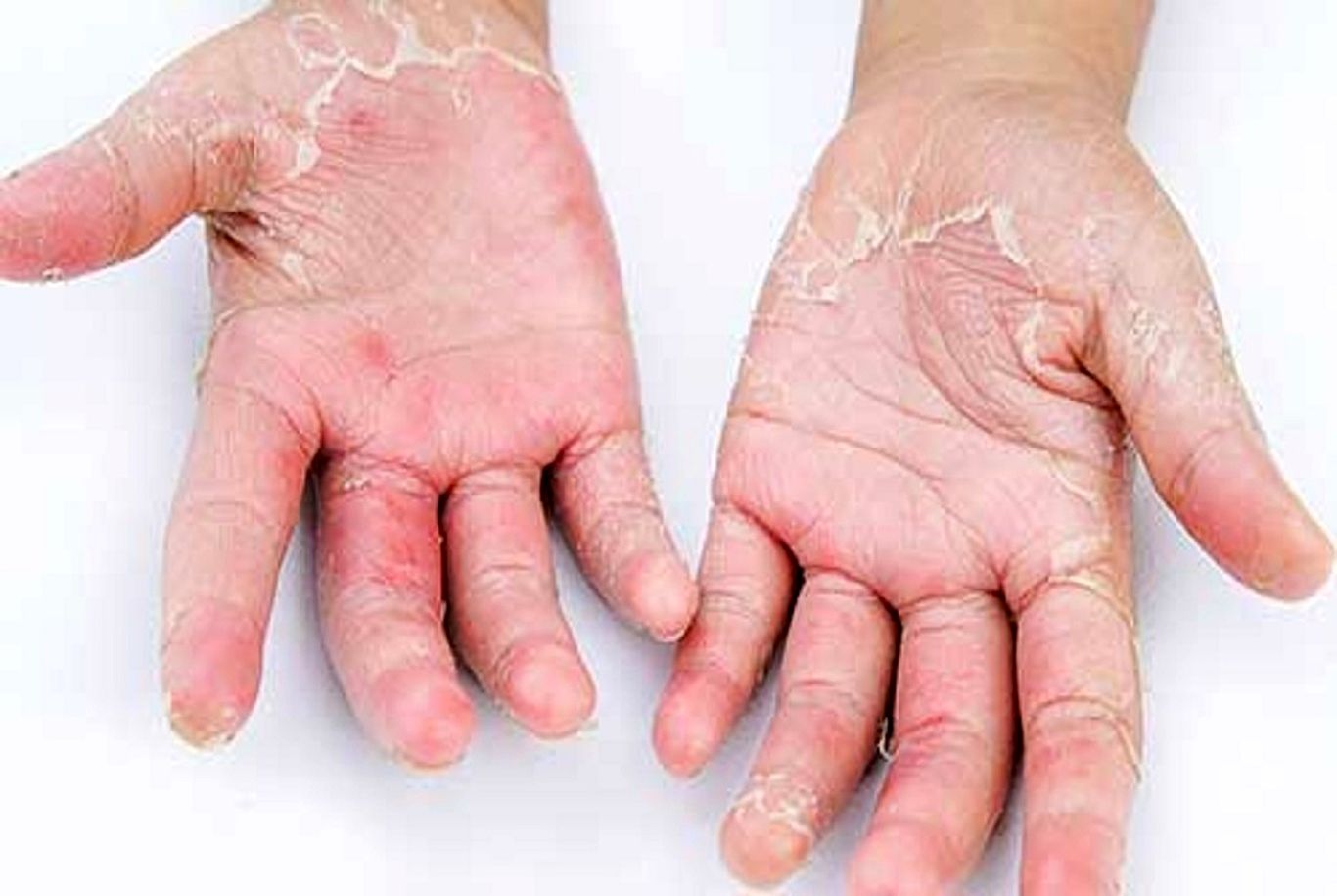 مراقب شایع‌ترین بیماری‌های پوستی در نوروز باشید