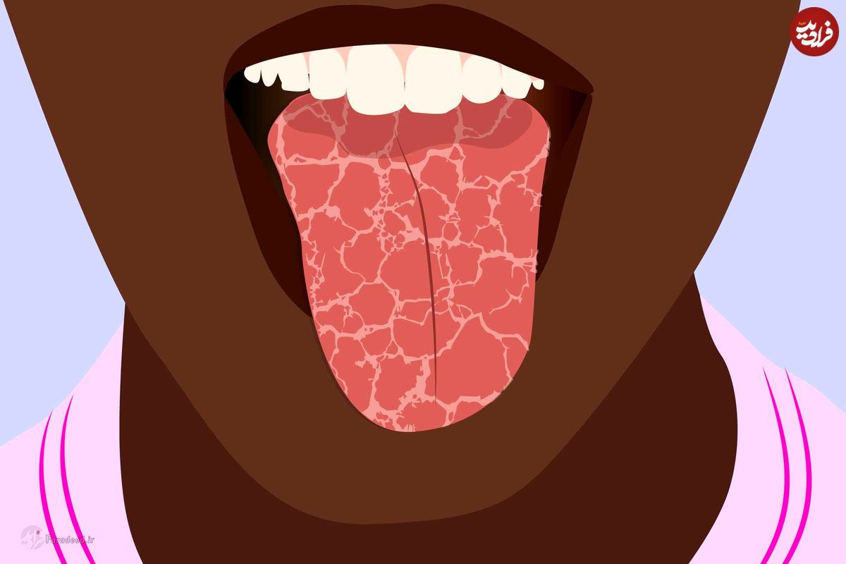 چگونه چسبندگی بزاق دهان را درمان کنیم؟