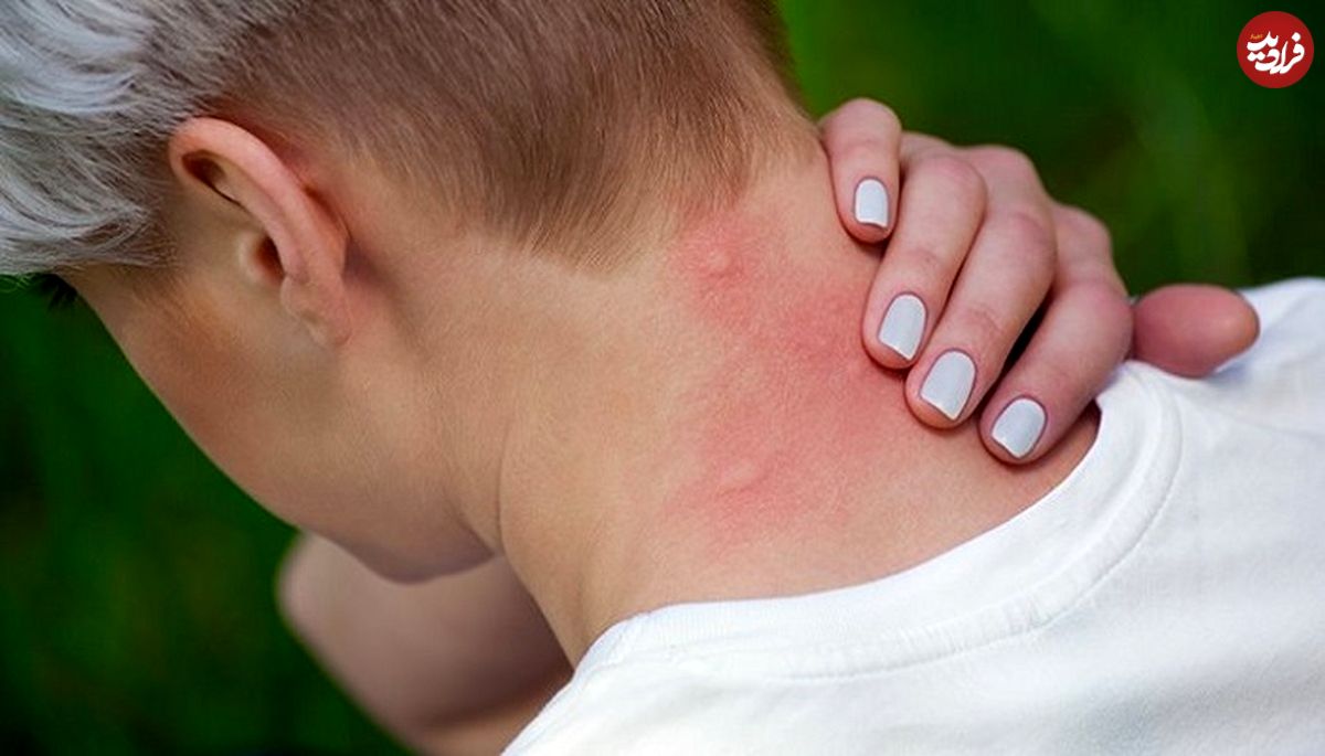 ۷ درمان خانگیِ نیش پشه‌ها