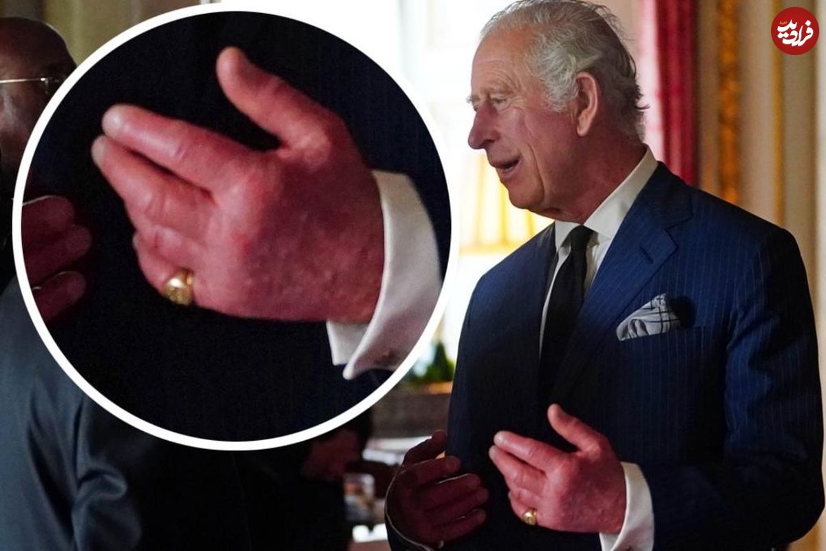 انگشتان ورم کرده شاه چارلز سوم؛ بیماری عجیب جانشین ملکه الیزابت چیست؟