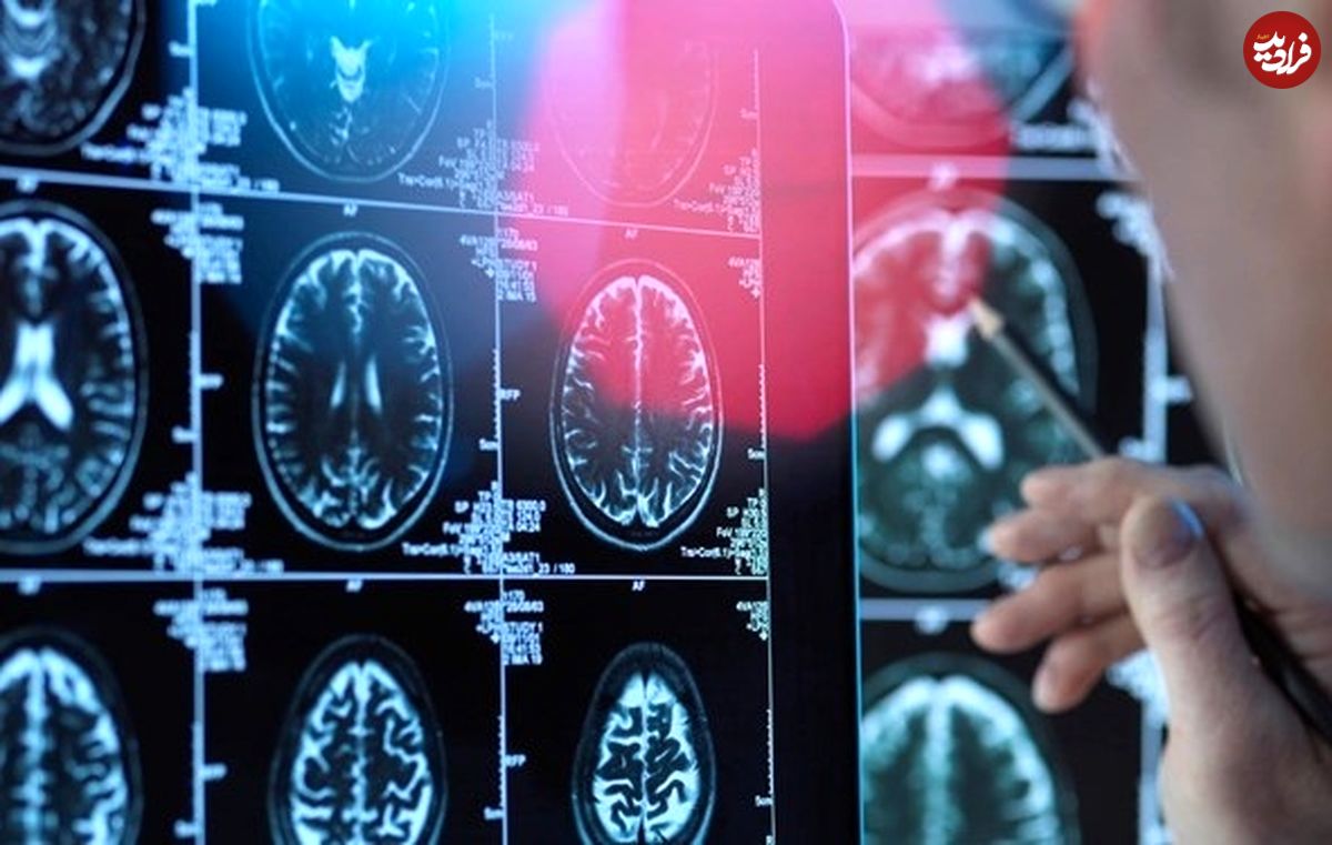 کشف راهکار تشخیص آلزایمر تا ۳ سال زودتر